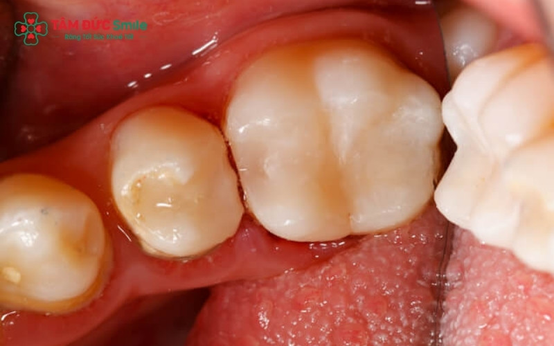 Trám răng lỗ nhỏ ngay từ sớm là giải pháp đơn giản nhất để ngăn chặn vi khuẩn tấn công vào tủy răng và tiết kiệm chi phí điều trị.