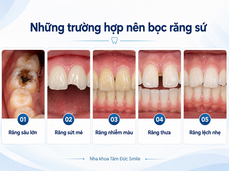 boc-rang-su-la-gi