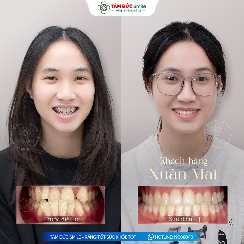 Niềng răng hỗ trợ điều chỉnh khớp cắn, cải thiện tương quan hai hàm.