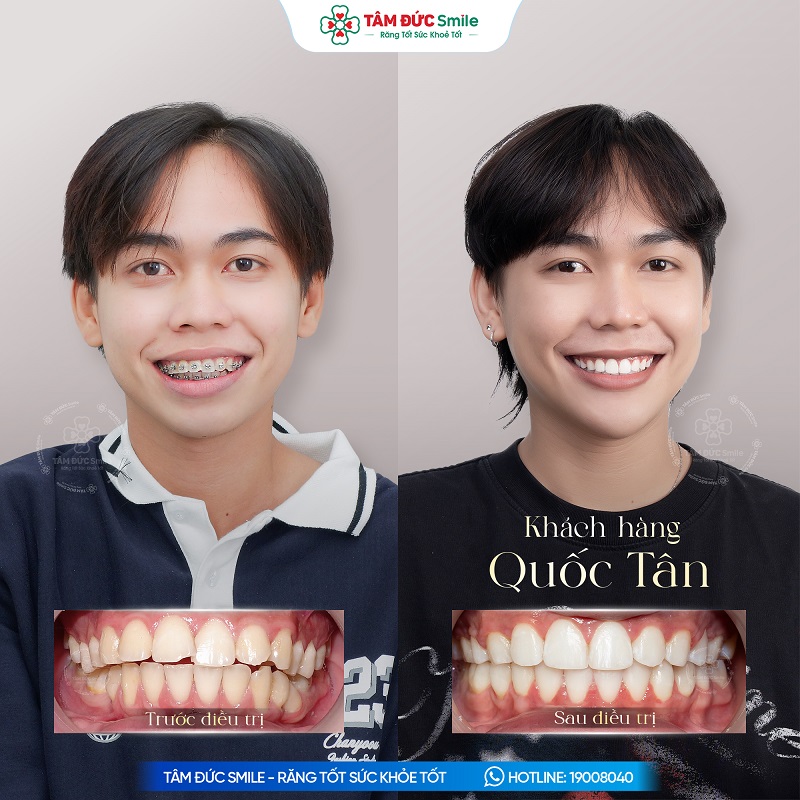 Kết quả niềng răng giúp răng đều đẹp, cải thiện thẩm mỹ nụ cười.